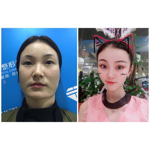 微整形