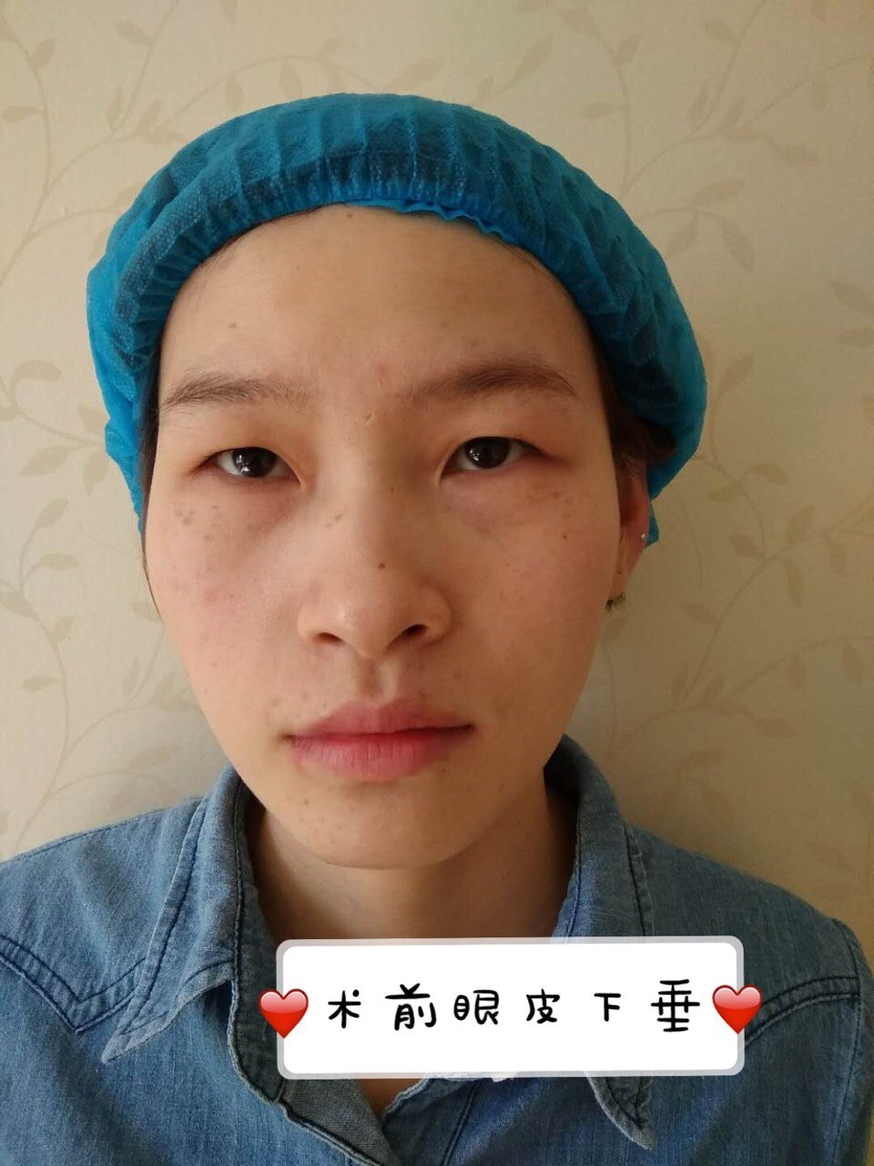 小眼睛的女孩子觉得做完双眼皮手术就够了,其实你还可能有上睑下垂喔