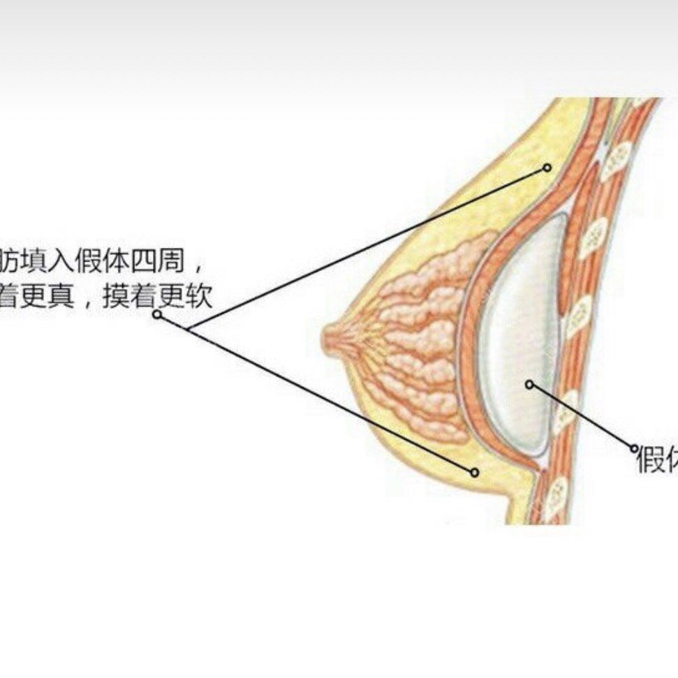 复合隆胸术科普时间