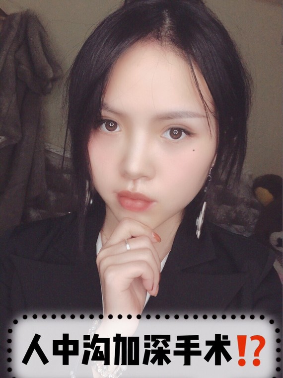 人中沟加深是什么操作6315什么是人中沟加深63