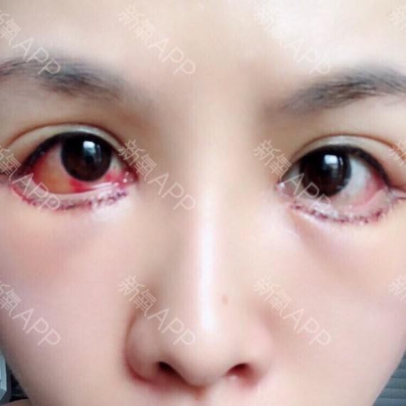 做下至手术后能让眼睛变大一倍