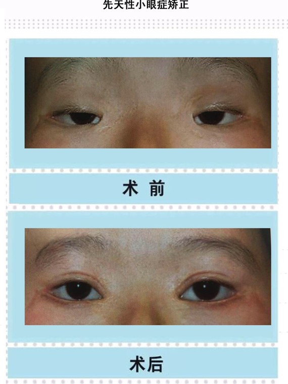新氧- 邢新 | 双眼皮 | 眼部修复 | 北京同城 | 电眼实验室 | 做的双