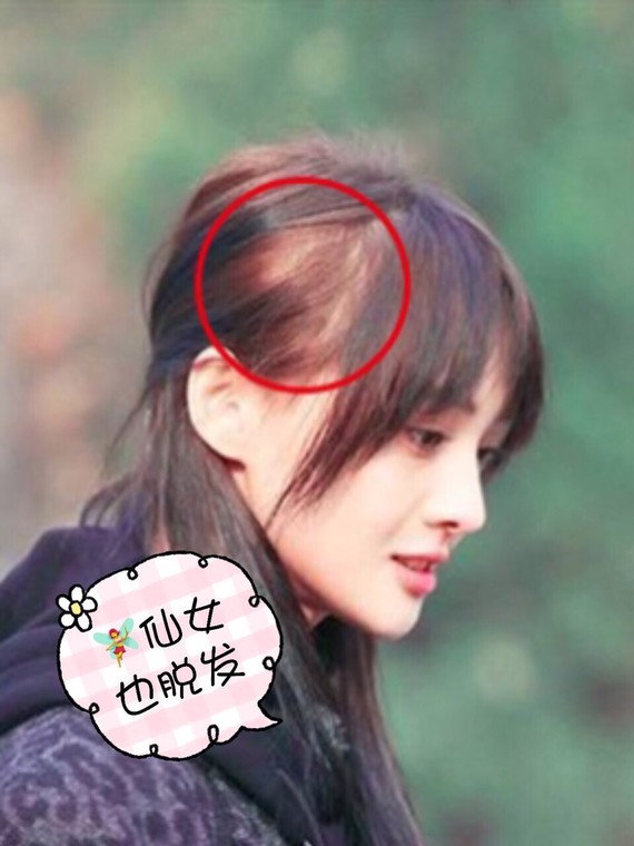 脱发的时间长了，毛囊是不是就会自动闭合?脱发的原因五花八门，_圈子-新氧美容整形