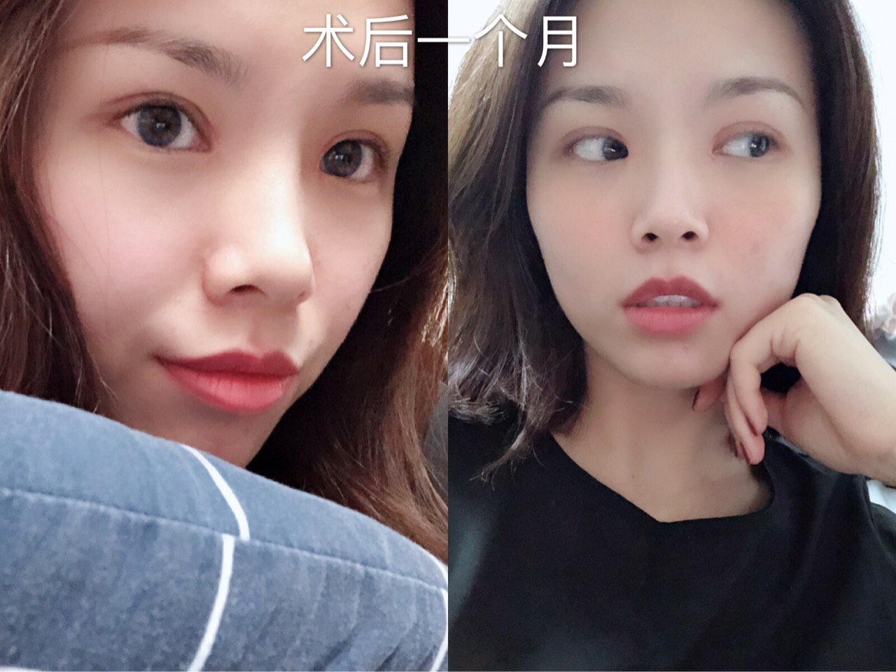 如何判断自己的眼皮松弛程度?