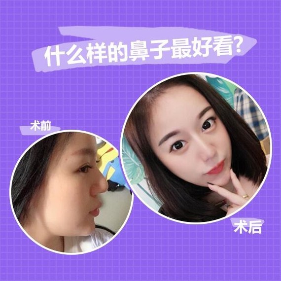 网上的鼻子类型分了特别多种,什么网红小翘鼻,混血鼻,水滴鼻,希腊鼻