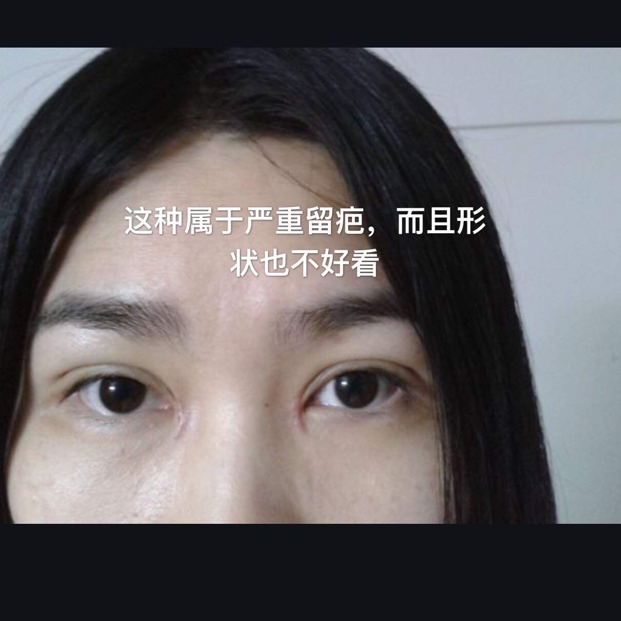 开眼角后留疤严重两年后我