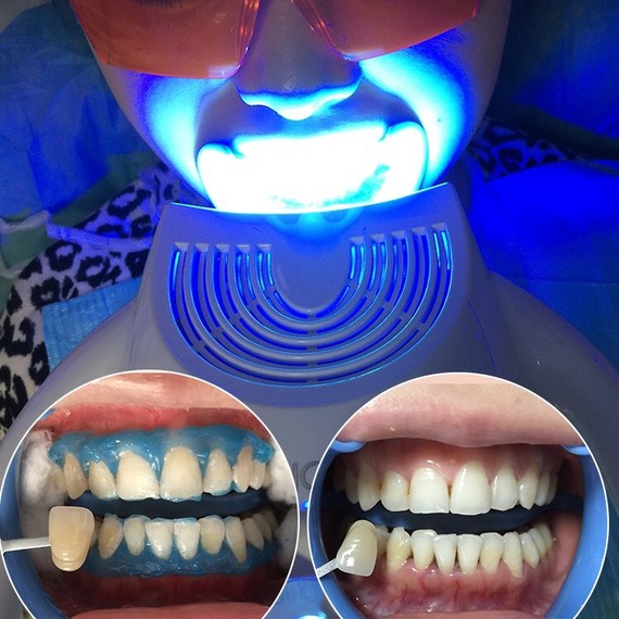 新氧- 氧气x6t7p | 牙齿美容 | 武汉同城 | 牙齿综合 | 牙齿抛光