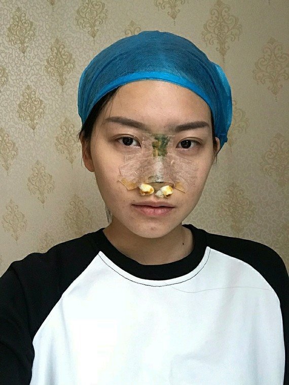 鼻小柱就是指两个鼻孔中间的那部分