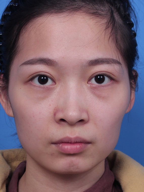 #面部脂肪填充多久可以恢复自然?能维持多少