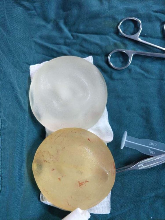 硅凝胶假体是目前隆胸手术中最常用的假体材料,其优点
