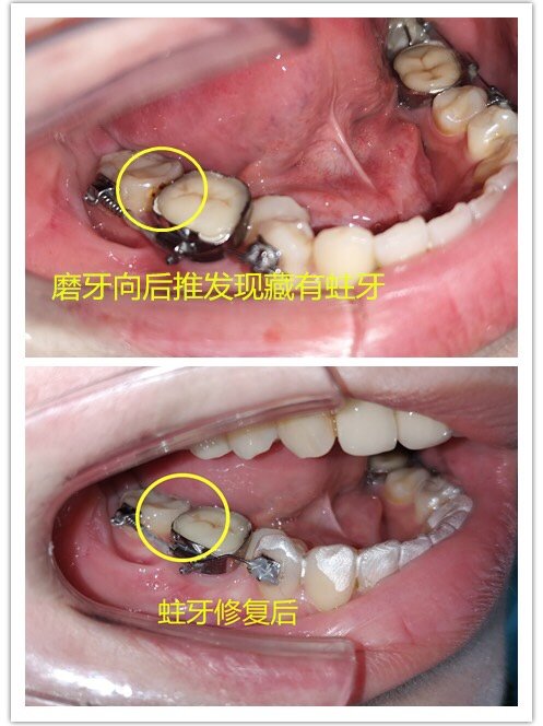 双侧大牙两颗