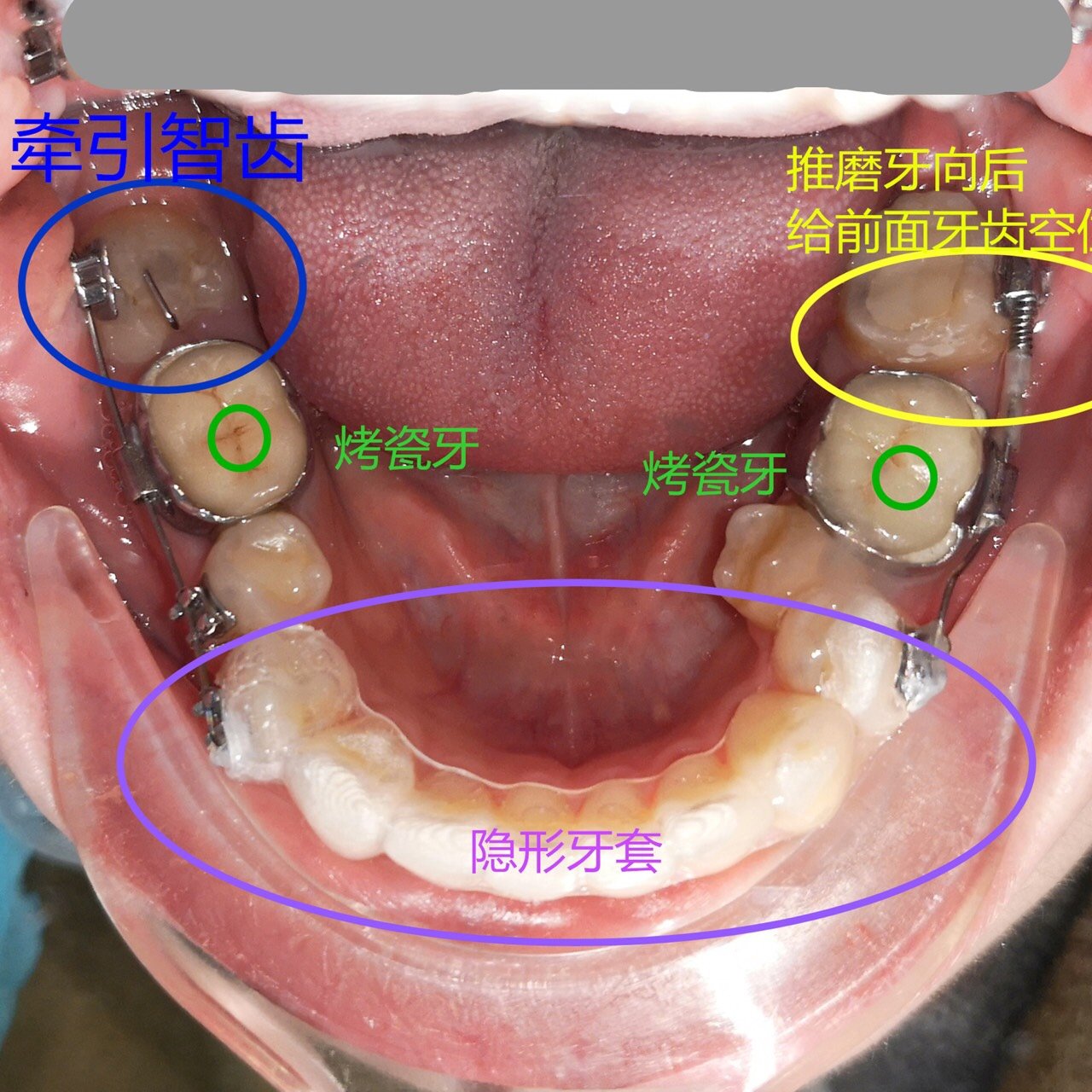 花式正畸:多技能结合治疗的一副下排牙.