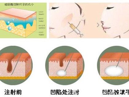 注射玻尿酸后为什么脸反而变小了