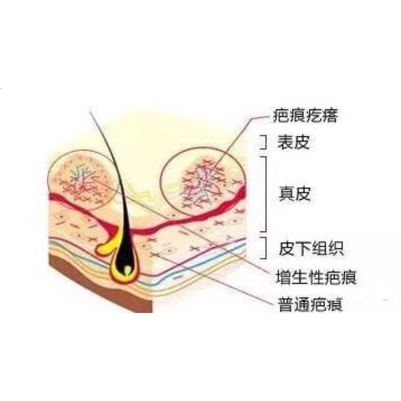 做完手术，我要如何区分疤痕疙瘩和增生性疤痕疤痕是我们生活中常常见到_圈子-新氧美容整形