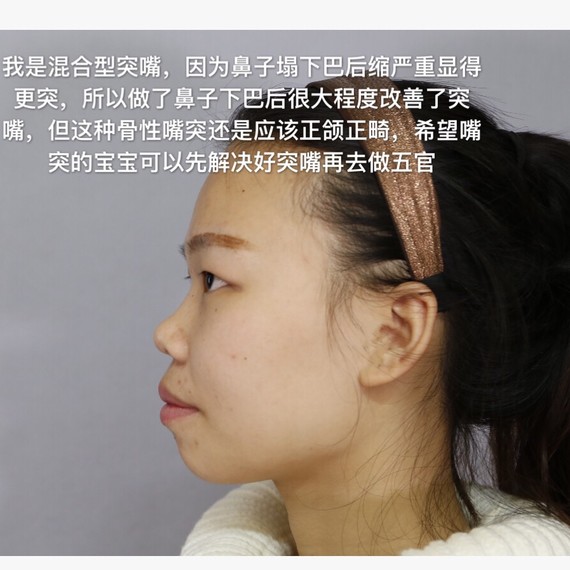 听说双鄂和突嘴手术你还分不清?