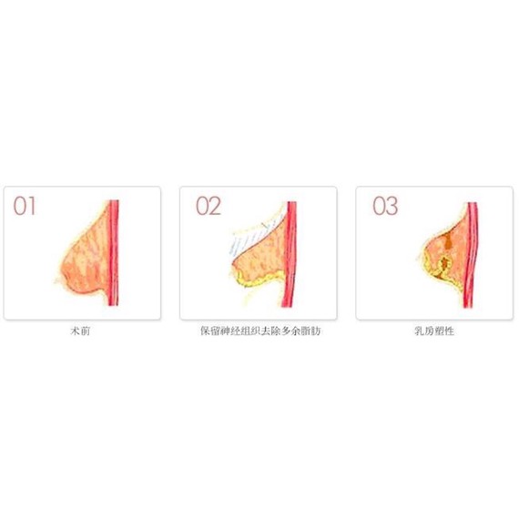 新氧- 袁伟 | 乳房下垂矫正 | 乳房缩小 | 武汉同城 | 乳房肥大矫正