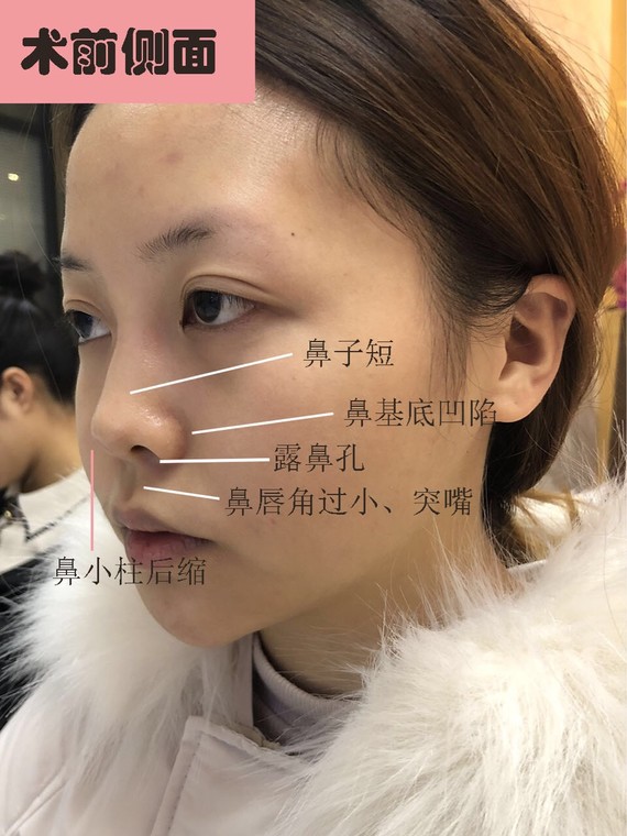 鼻翼缘后缩导致露鼻孔?来听听我的解决方案.