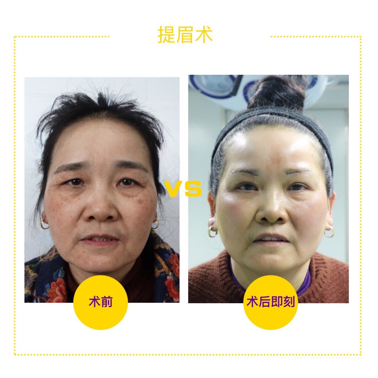 提眉能省个双眼皮的钱,你不知道吧!