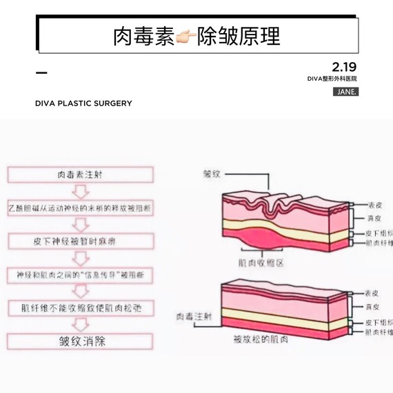 肉毒素,除了瘦脸还有这么多用途啊!