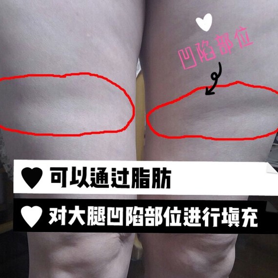 自体脂肪可以填充大腿凹陷的地方吗?自体脂肪除了可以