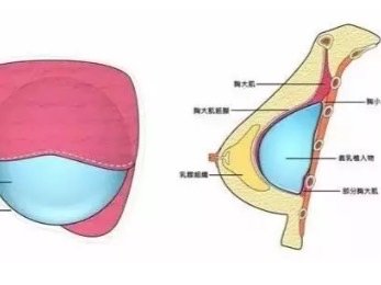 假体隆胸会影响敏感度吗?