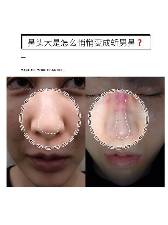 你有没有过对着镜子里自己宽大的鼻头唉声叹气的情况呢?