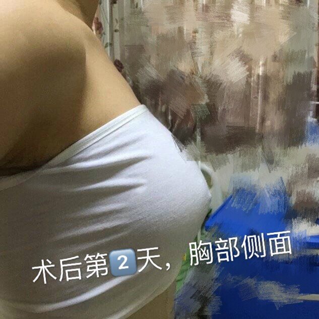 脂肪隆胸三个多月后男朋友说捏起来好弹好软