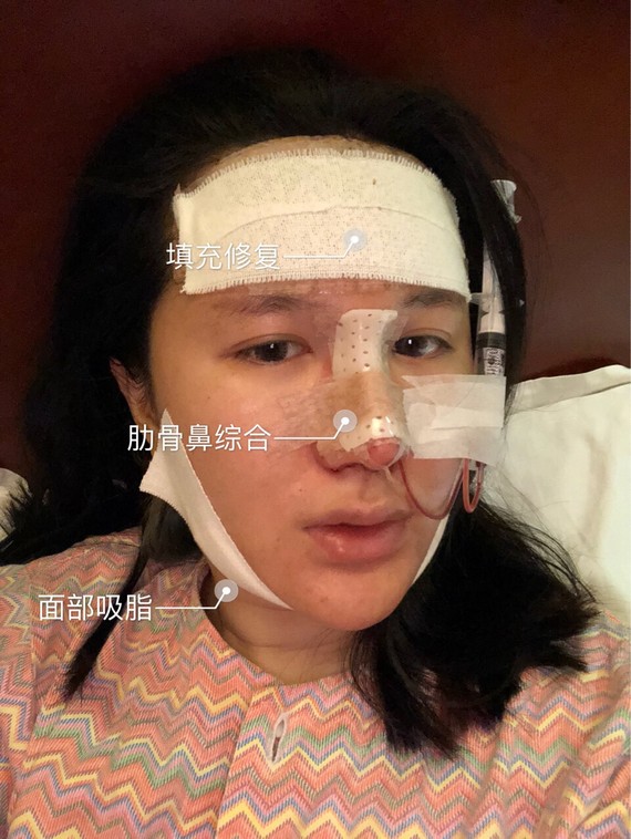 第一次取我是局部麻醉的,所以很清醒的看到了骨粉被取出,只是血肉模糊