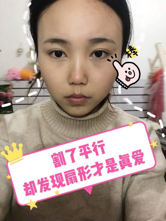 做了平行双眼皮,但是很想要扇形怎么办?