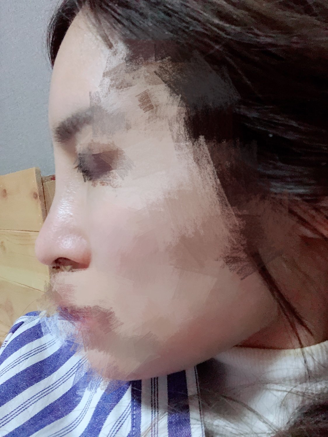 9月30号在南京科芮恩整形美容医院做了肋骨鼻