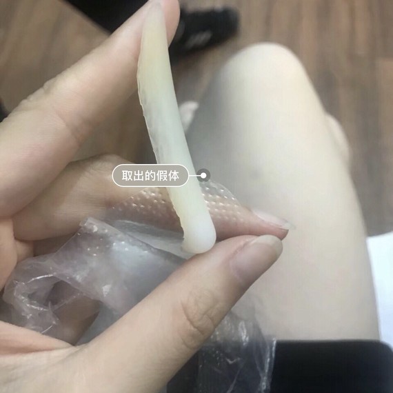 隆鼻假体取出后能回到原样吗