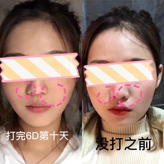 韩国6D小脸针瘦脸针真的好用到哭,用了这个真