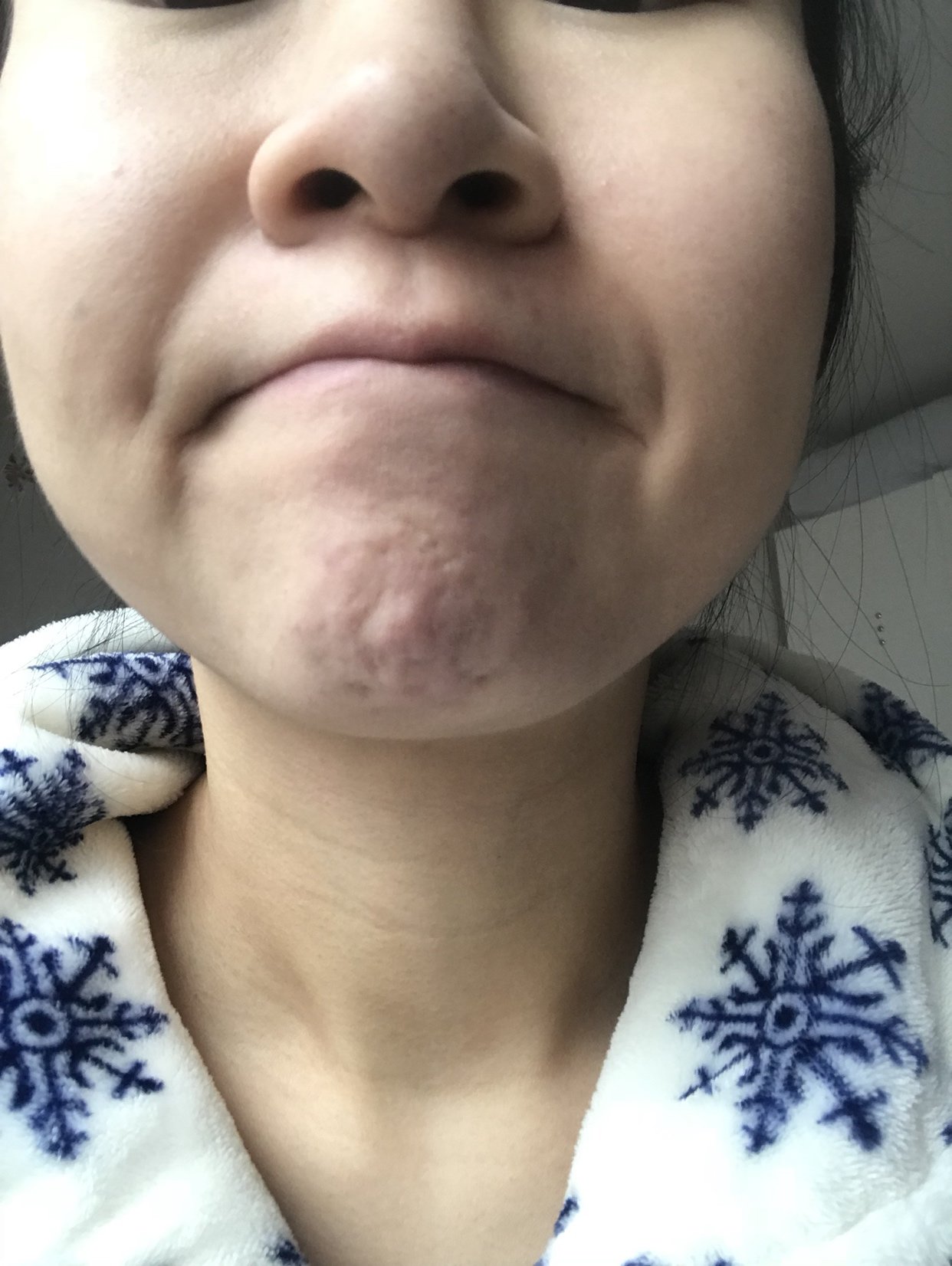 我是10年在美容院被骗下巴注射了所谓的玻尿酸!结果多