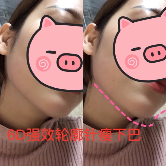 韩国6D小脸针瘦脸针真的好用到哭,用了这个真