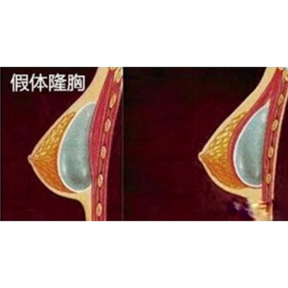 我要隆胸(上)变大波之前需要了解的那些事