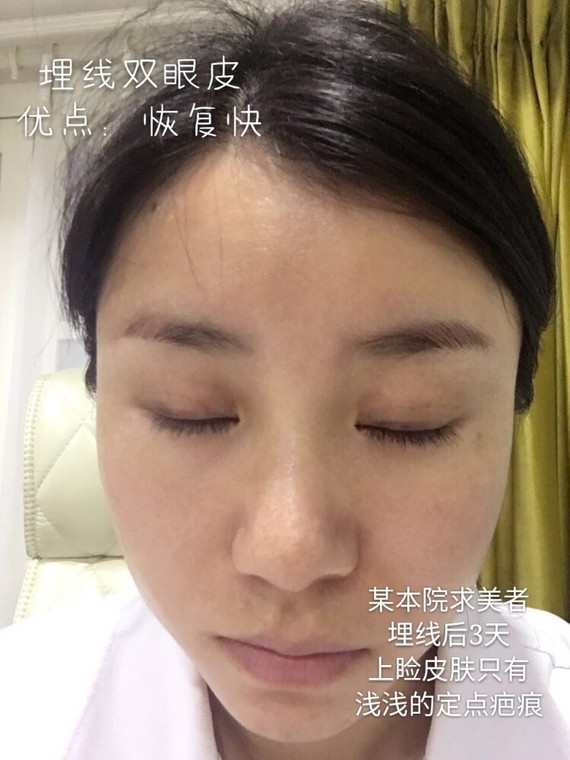 做埋线双眼皮失败了,可以把线拆掉吗?