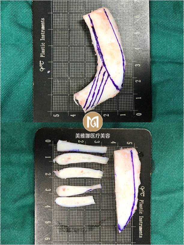91肋软骨隆鼻系列科普—肋软骨材料及处理解_圈子-新氧美容整形