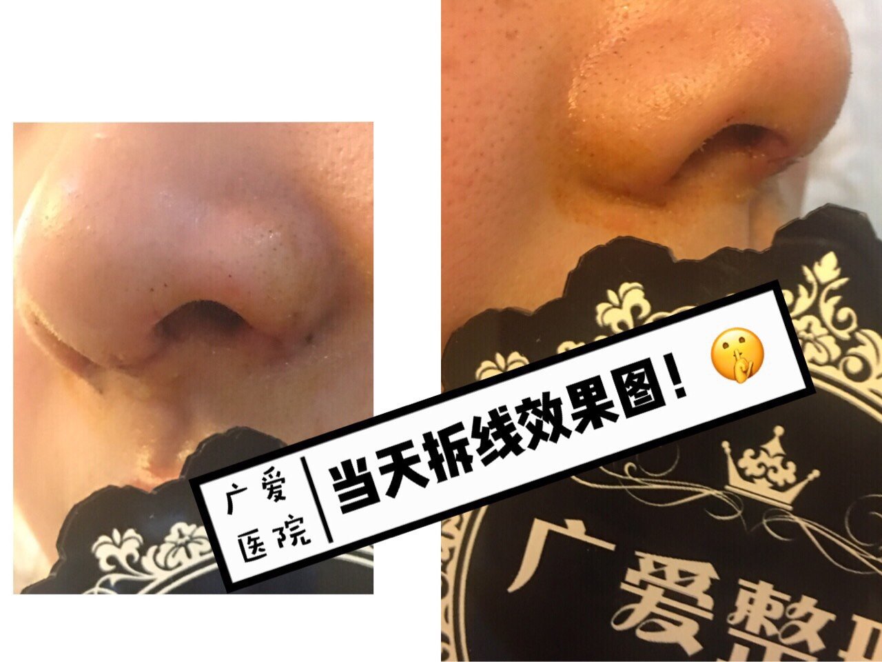 是不是很好奇,一个简单的缩鼻翼手术,就能提升整体颜值和气质?