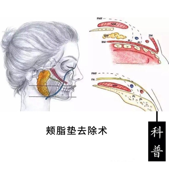 面部吸脂和去颊脂垫手术的区别