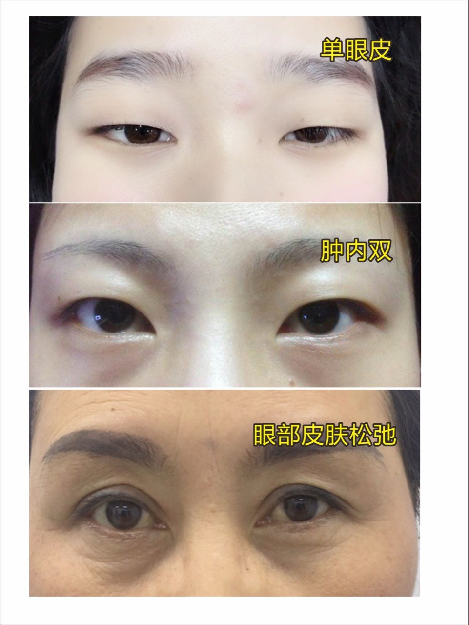眼皮松弛下垂,做双眼皮还是提眉术?