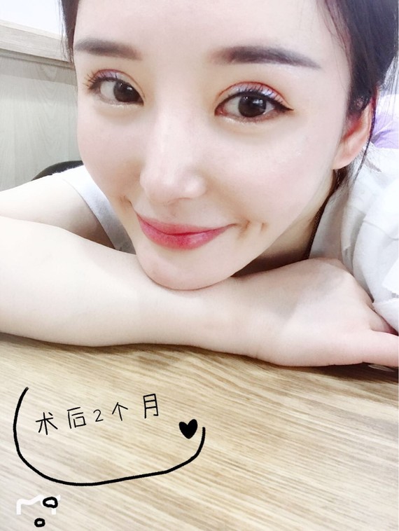 95酒窝埋线95酒窝成型95我也要小酒窝9696.