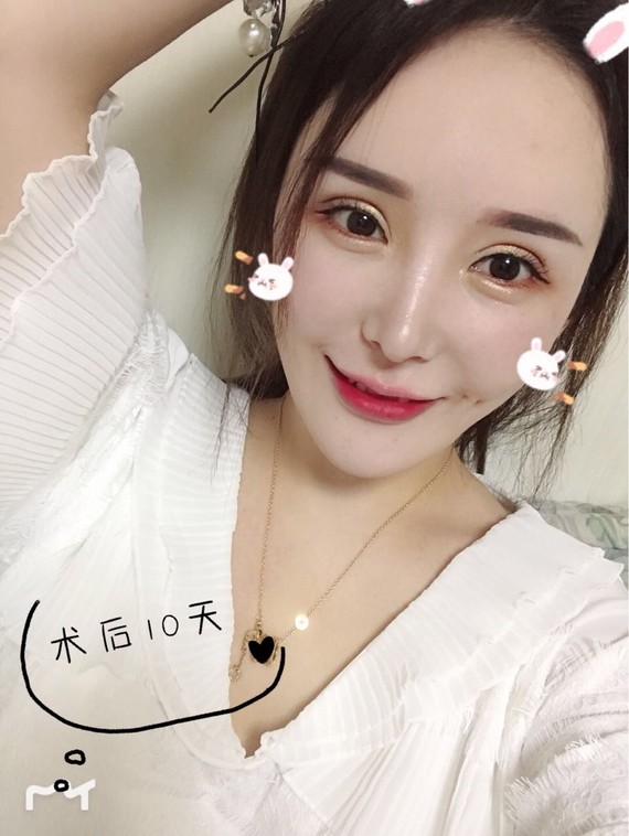 95酒窝埋线95酒窝成型95我也要小酒窝9696.