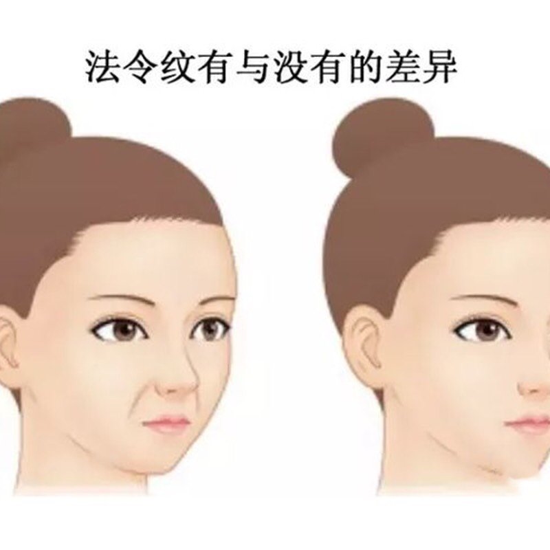 少女型法令纹或衰老型法令纹78法令纹