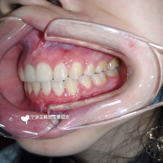 关于骨性牙凸,单纯做牙齿有多大变化?