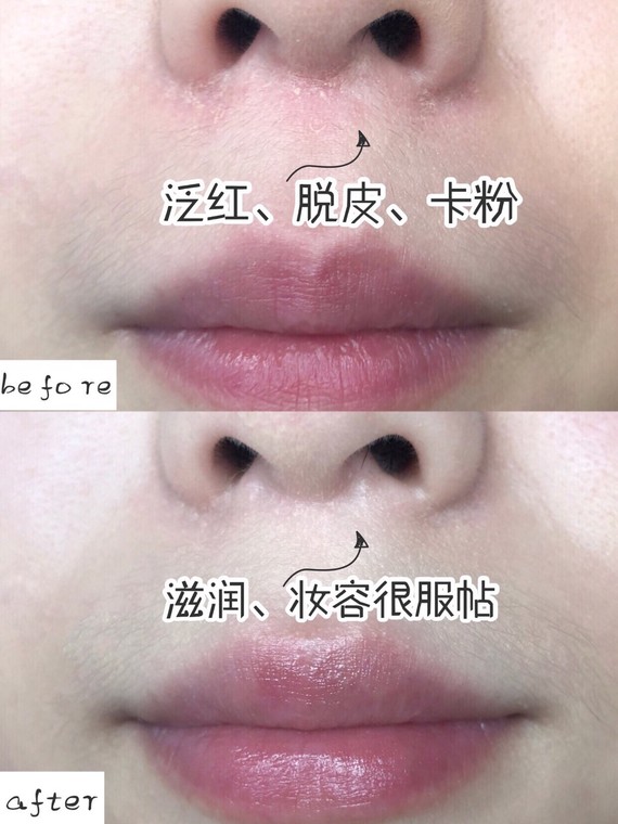 冬天鼻翼周围泛红7515脱皮7515卡粉7515
