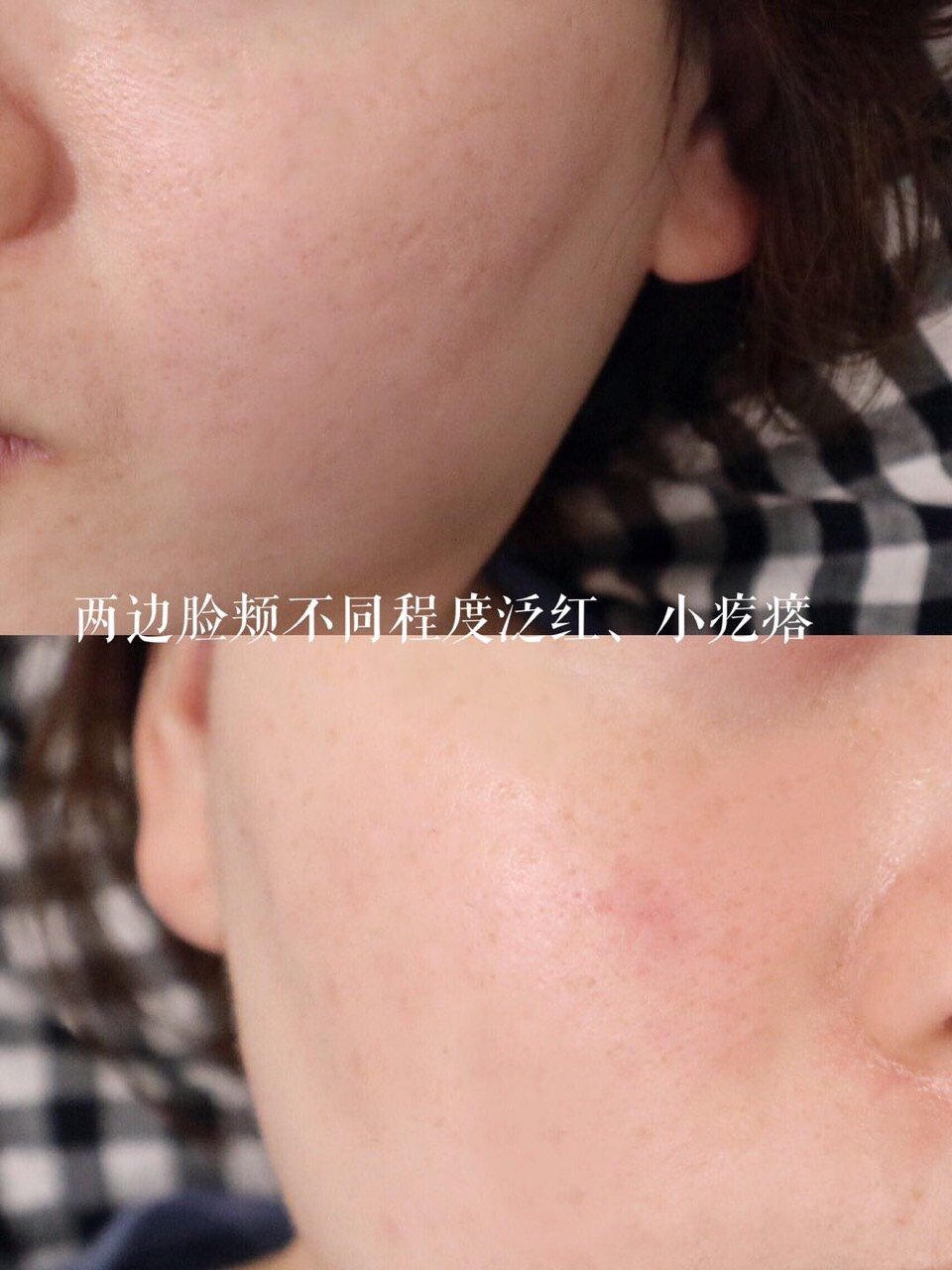 换季拯救敏感肌功课,泛红小疙瘩肌肤的护肤流程
