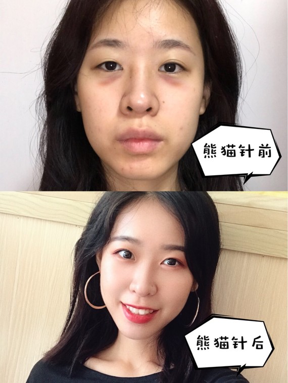 9173第一次尝试香港医美打泰奥熊猫针,效果比明星
