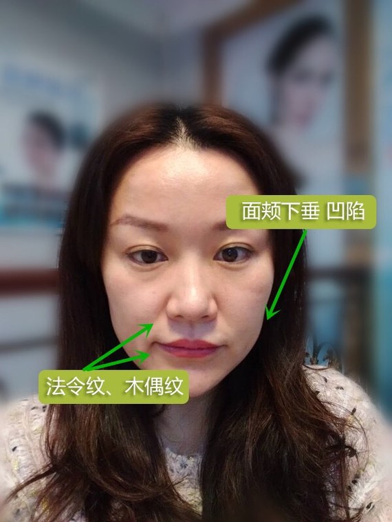 面部提升