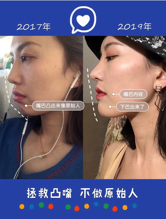 拯救凸嘴,摆脱原始人!整牙就够了不用整容