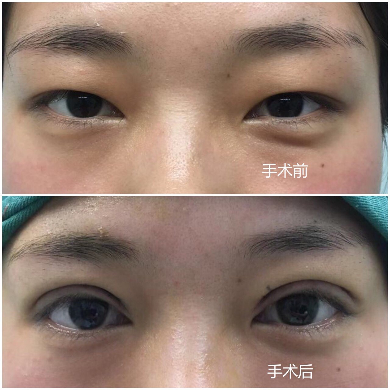 眉眼间距近可以做双眼皮吗